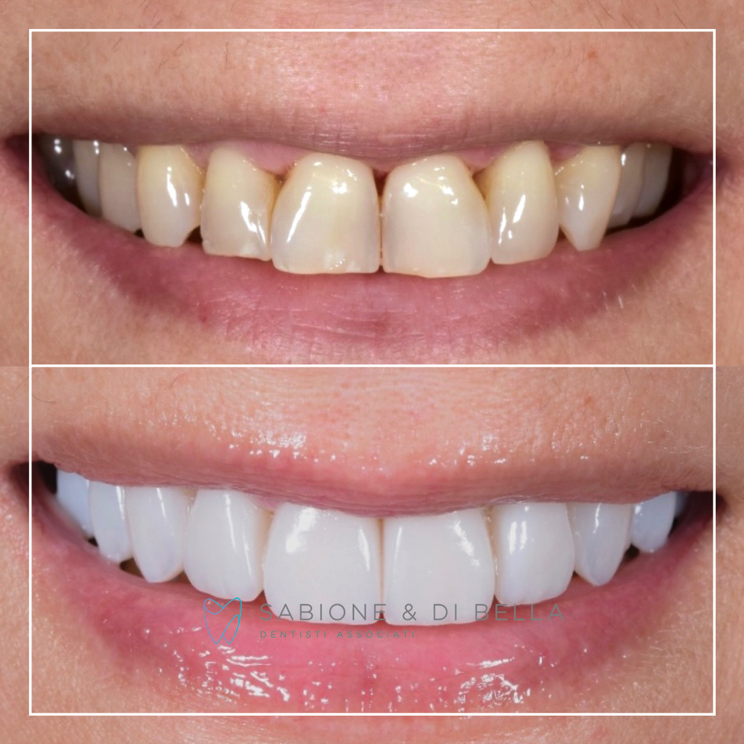 Foto prima e dopo di denti